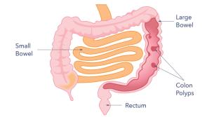 Dr Peter Moore: Spot the early signs of bowel cancer to save your life