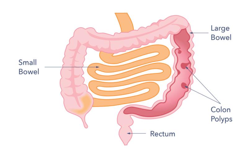 Look after your bowels