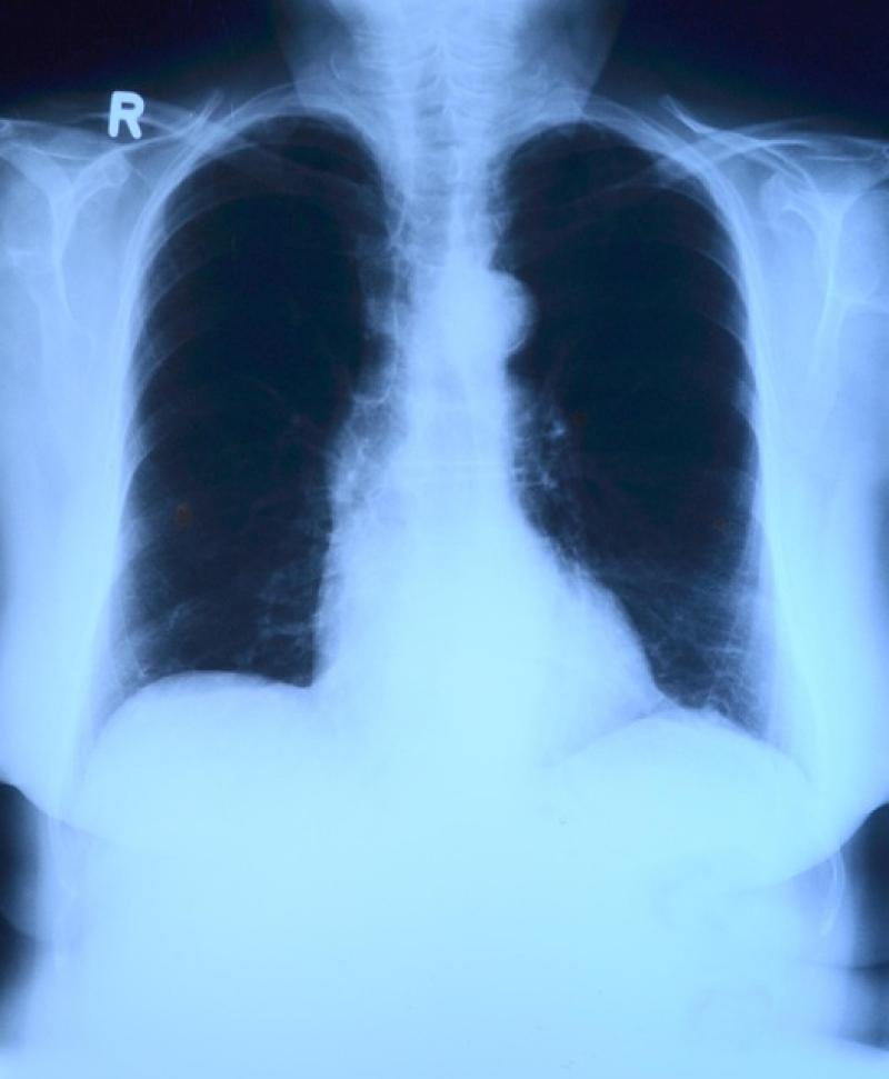 Medical Matters: What to look for when it comes to lung cancer